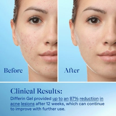 Differin Retinoid Acne Treatment; Adapalene Gel 0.1% 45g/1.6oz - New